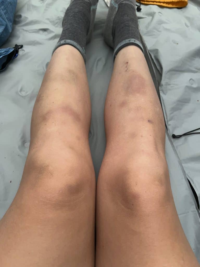 Cindy Bruised Legs